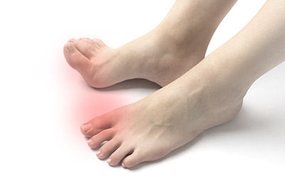 高尿酸血症(痛風)のイメージ画像